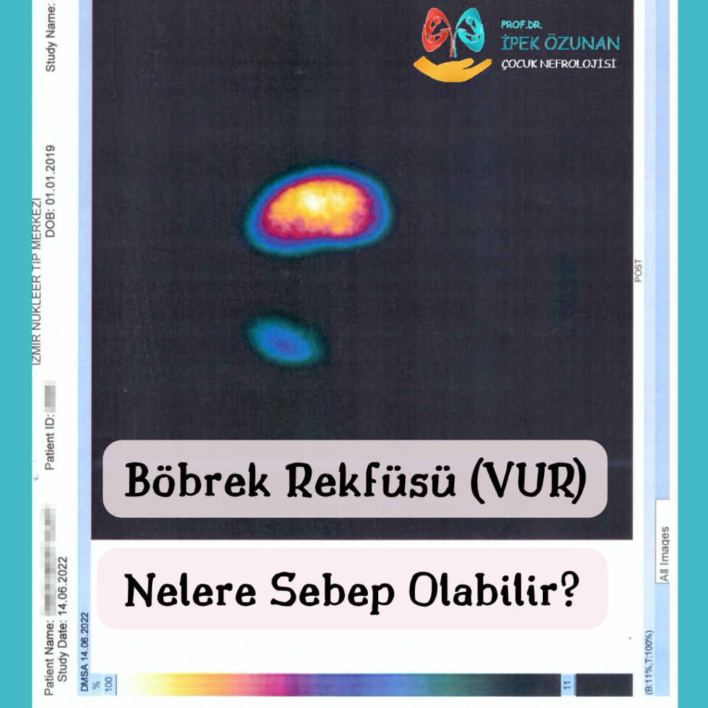 Böbrek Reflüsü (VUR) Nelere Sebep Olabilir?