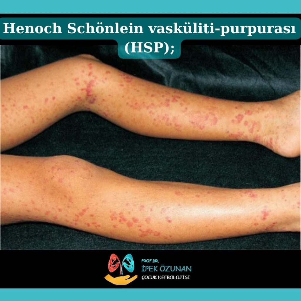 Henoch Schönlein vasküliti-purpurası (HSP);